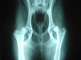 Hip dysplasia